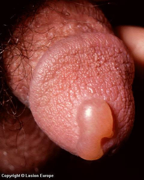 herpes picture