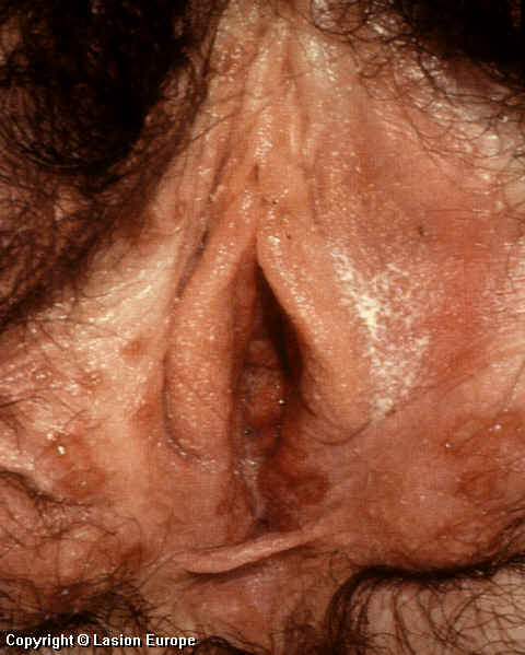 herpes picture