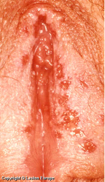 herpes picture