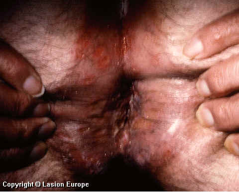 herpes date herpes date