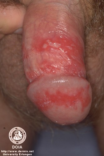 herpes picture