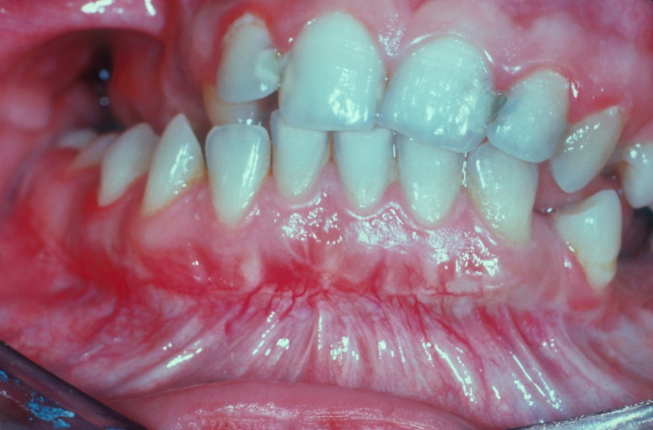 herpes picture
