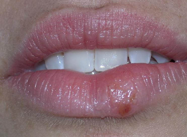 herpes date herpes date